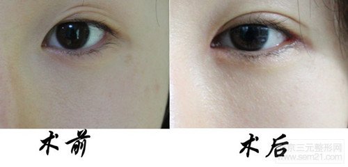 开外眼角术前术后对比图 开外眼角价格介绍