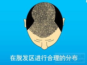 FUT单体毛囊植发第七步 FUT单体毛囊植发第七步