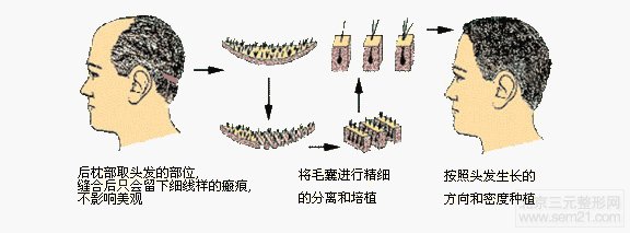 FUT单体毛囊植发术 FUT单体毛囊植发术