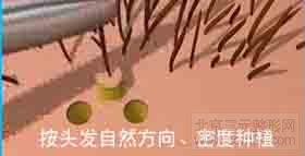 FUT单体毛囊植发第九步 FUT单体毛囊植发第九步