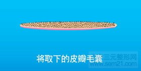 FUT单体毛囊植发第三步 FUT单体毛囊植发第三步