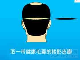 FUT单体毛囊植发第二步 FUT单体毛囊植发第二步