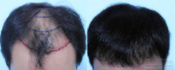 FUT单体毛囊植发对比图 FUT单体毛囊植发对比图