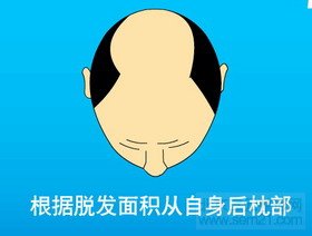 FUT单体毛囊植发第一步 FUT单体毛囊植发第一步