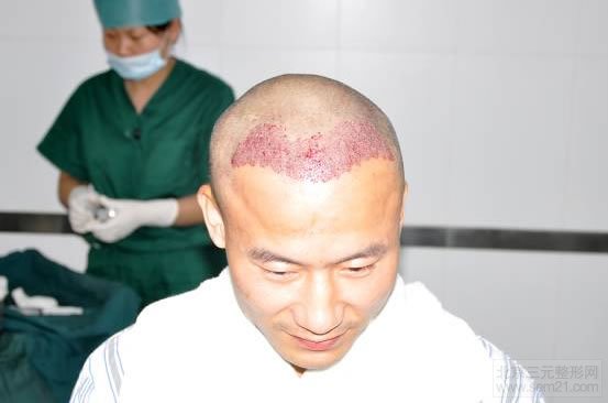 FUE植发术 种植成功 FUE植发术 种植成功