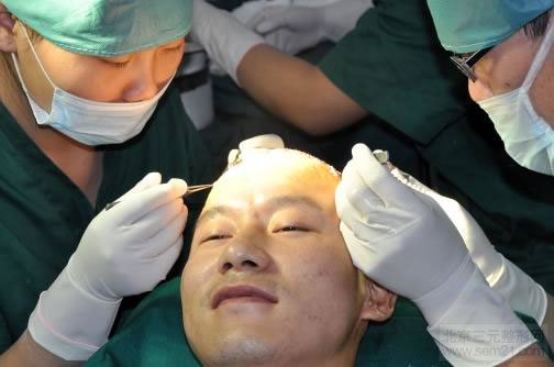FUE植发术 种植 FUE植发术 种植