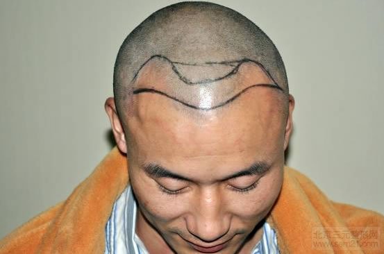 FUE植发术 方案设计 FUE植发术 方案设计