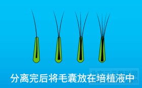 FUT单体毛囊植发第五步 FUT单体毛囊植发第五步