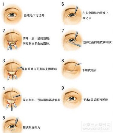 外切法去眼袋手术示意图 外切法和激光去眼袋