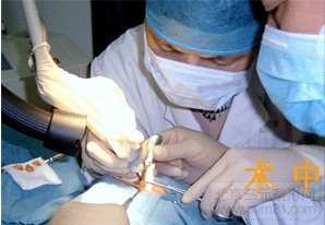 激光去眼袋 手术中 外切法和激光去眼袋