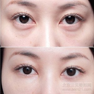 激光去眼袋 前后对比照 外切法和激光去眼袋