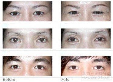 人工卧蚕整形术 前后对比图 人工卧蚕整形术 前后对比图