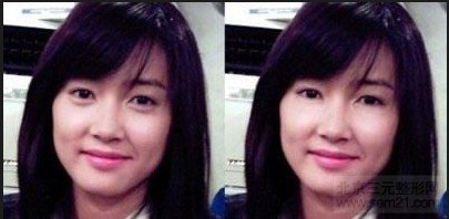 卧蚕眼P掉前后对比 卧蚕眼P掉前后对比