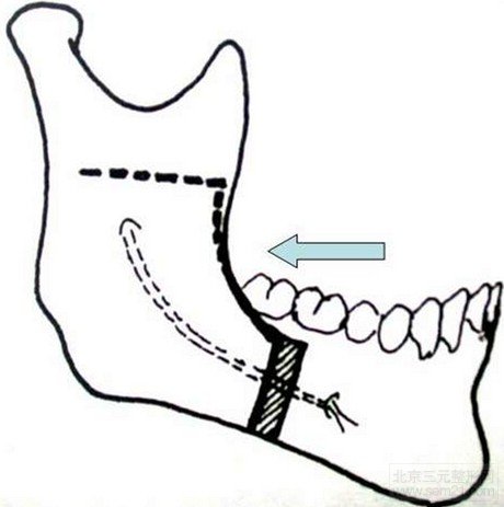 上颌骨前移矫正地包天手术示意图 上颌骨前移矫正地包天手术示意图