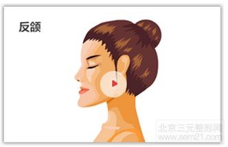 下颌骨前突(反颌)示意图 下颌骨前突(反颌)示意图