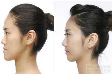 上颌骨前移矫正地包天手术前后对比图 上颌骨前移矫正地包天手术前后对比图