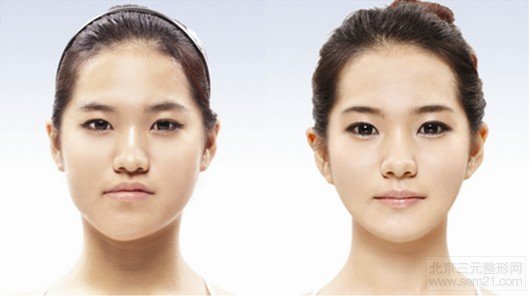 求美者体验下颌骨后后缩矫正地包天手术前后效果展示 求美者体验下颌骨后后缩矫正地包天手术前后效果展示