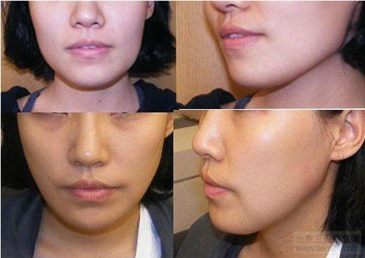 求美者体验口内外联合切口下颌角切除术效果展示