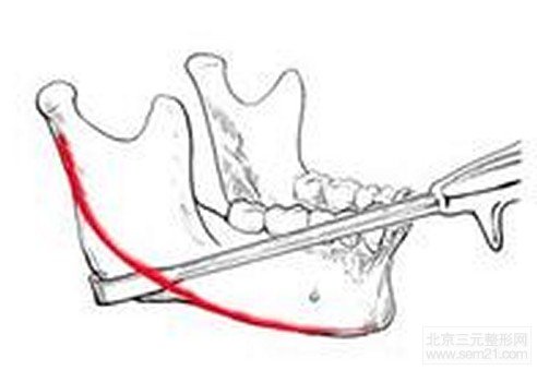 求美者体验口内切口下颌角切除术前后效果展示