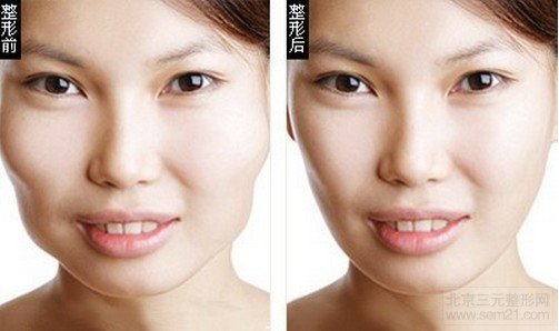 求美者体验耳后切口下颌角切除术前后效果展示