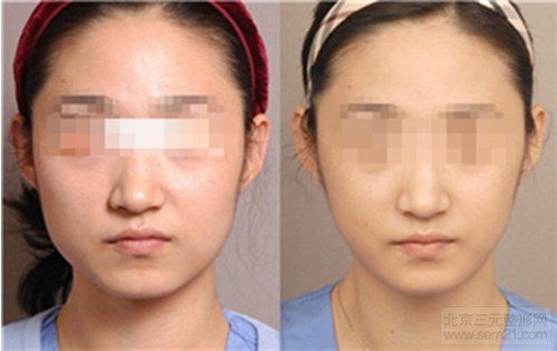 求美者体验咬肌肥大切除术手术前后效果展示 求美者体验咬肌肥大切除术手术前后效果展示