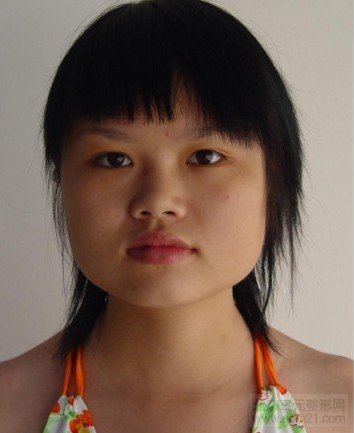 咬肌肥厚示例图 咬肌肥厚示例图