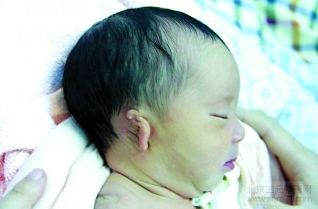 什么是小耳畸形? 什么是小耳畸形?