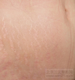 妊娠纹怎么去除?有哪些方法?多少钱?