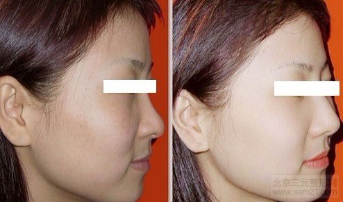 注射前后对比图