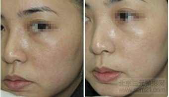 果酸嫩肤对比图 嫩肤有哪些方法,激光,光子嫩肤果好吗?