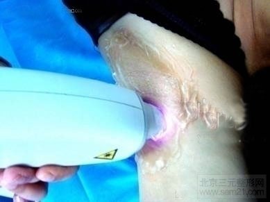 E光脱毛治疗 E光脱毛治疗