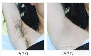 光子脱毛前后对比图 光子脱毛前后对比图