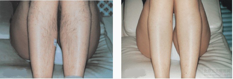 激光脱毛前后对比图 激光脱毛前后对比图