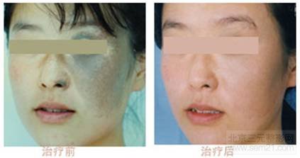 光子调节太田痣对比图 怎样去太田痣,哪家医院好?