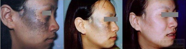 激光调节太田痣对比图 怎样去太田痣,哪家医院好?