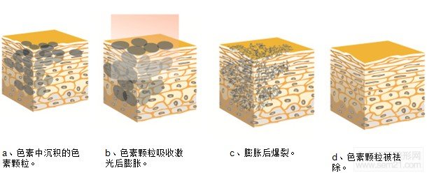 E光调节太田痣解说图 怎样去太田痣,哪家医院好?