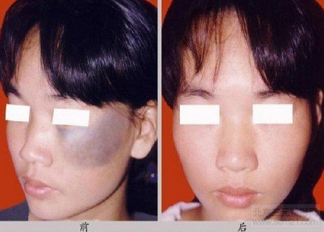 皮肤磨削治太田痣对比图 怎样去太田痣,哪家医院好?