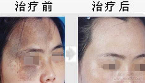 E光调节太田痣对比图 怎样去太田痣,哪家医院好?