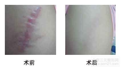 激光治疗瘢痕前后对比图 激光治疗瘢痕前后对比图