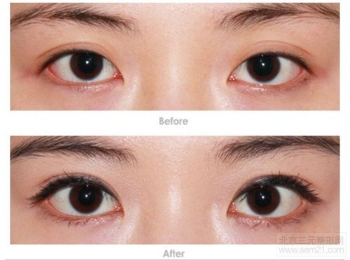 开内眼角手术 前后对比图 开内眼角手术 前后对比图