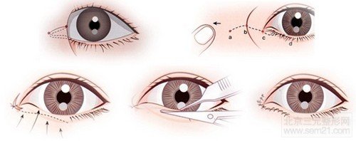 Z成形法内眦开大术 手术示意图 Z成形法内眦开大术 手术示意图