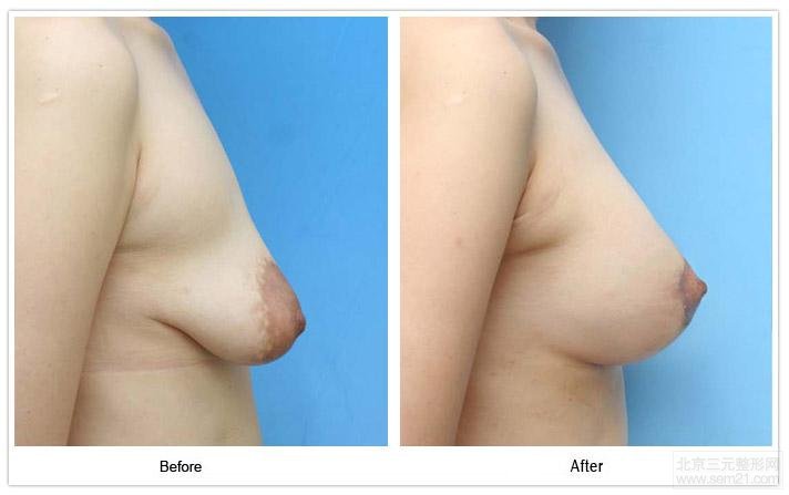 韩国乳房下垂提升案例图
