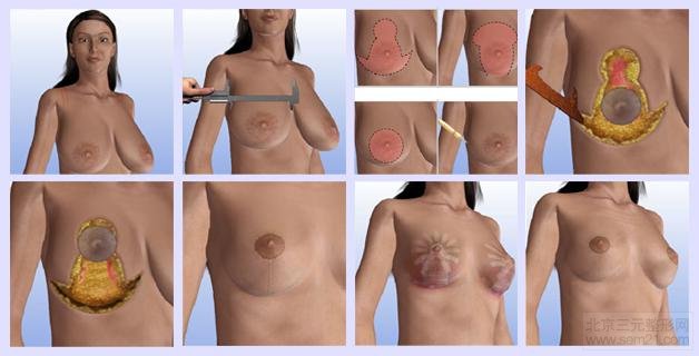 巨乳缩小手术过程图