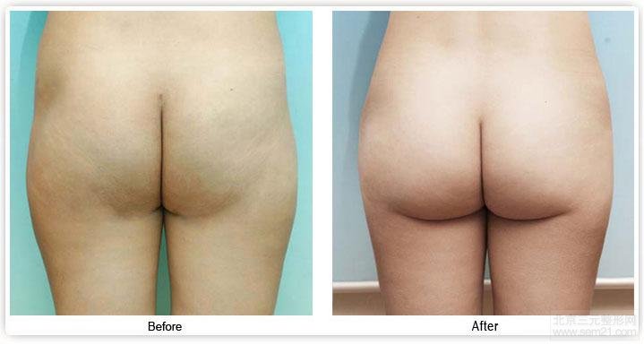 自体脂肪丰臀案例