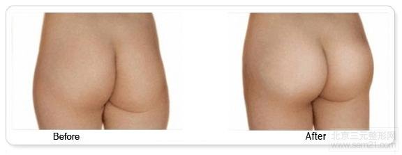 假体丰臀案例图