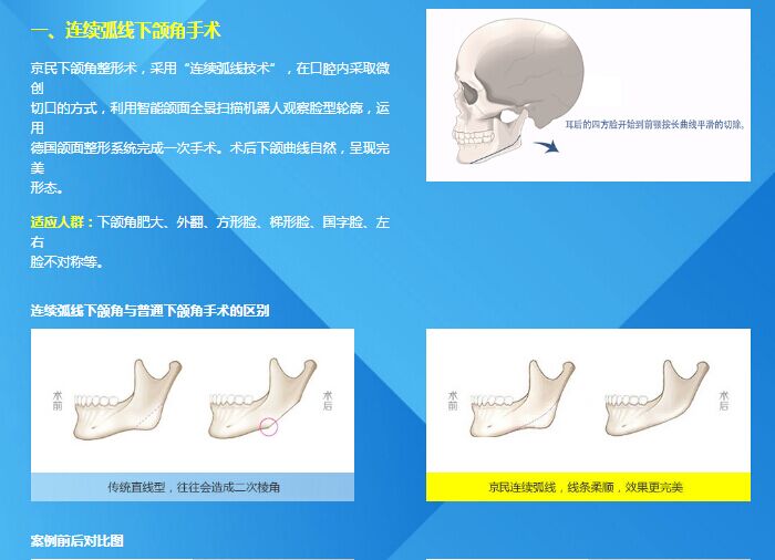 北京京民医院下颌角磨骨多少钱？好吗？