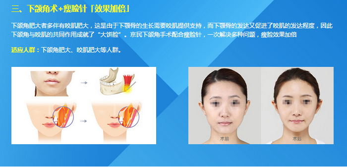 北京京民医院下颌角磨骨多少钱？好吗？