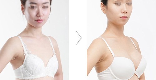 上海长征医院朱晓海隆胸案例 上海长征医院整形科朱晓海隆胸多少钱?好吗?