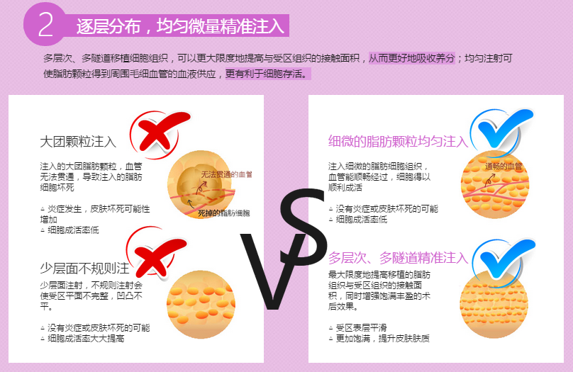 上海华美袁玉坤自体脂肪填充 上海华美袁玉坤自体脂肪隆胸多少钱?好吗?