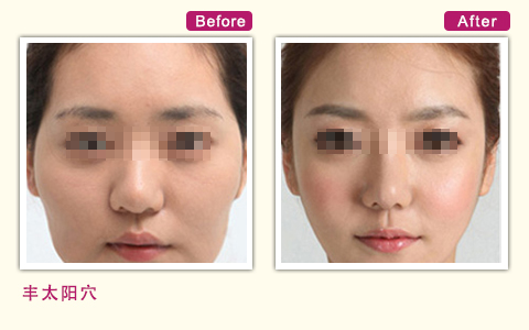 北京玉之光王明利丰太阳穴案例图 北京玉之光王明利吸脂隆胸多少钱?案例图?